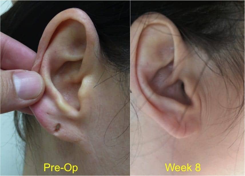 Skin Surgery Photos Cyst and Lipoma Removal & Earlobe Repair