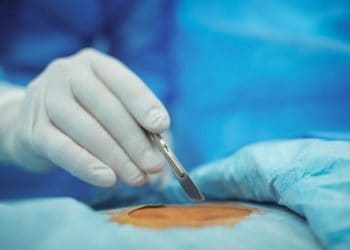 Cyst Removal London