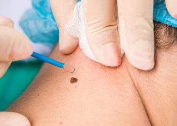 Skin Tag Removal London