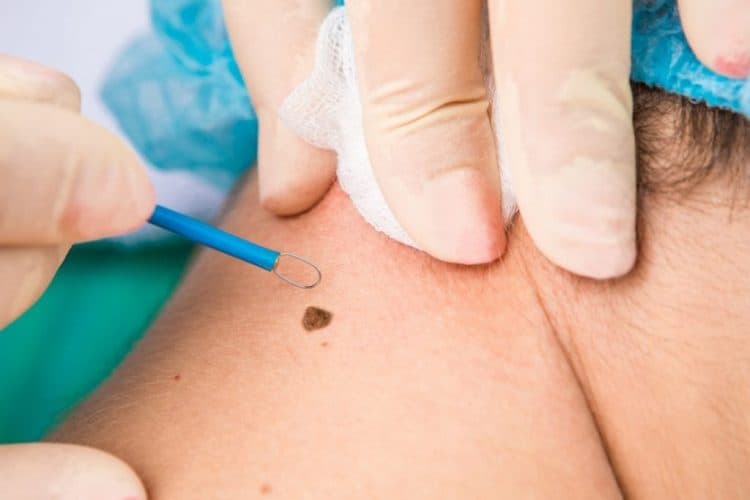 Skin Tag Removal London